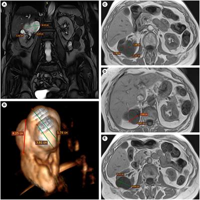 A Case Report of Calyceal Diverticulum: Differential Diagnosis for Organ-Preserving Operations